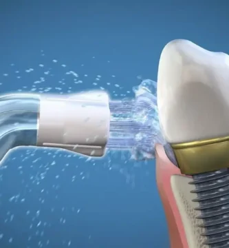 Implantes irrigador dental