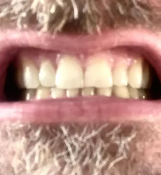 Experiencia con el bruxismo